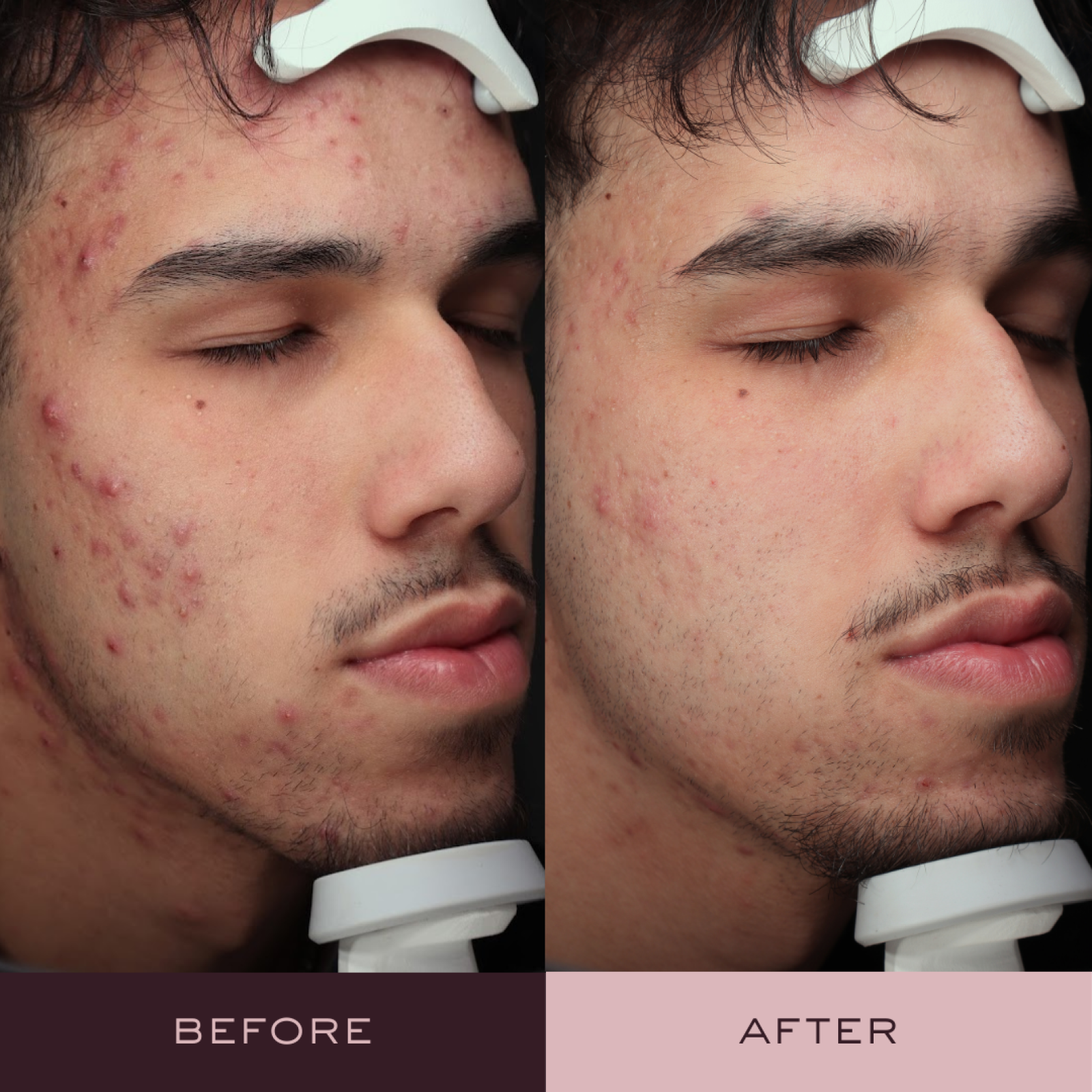Before and after AviClear acne treatment