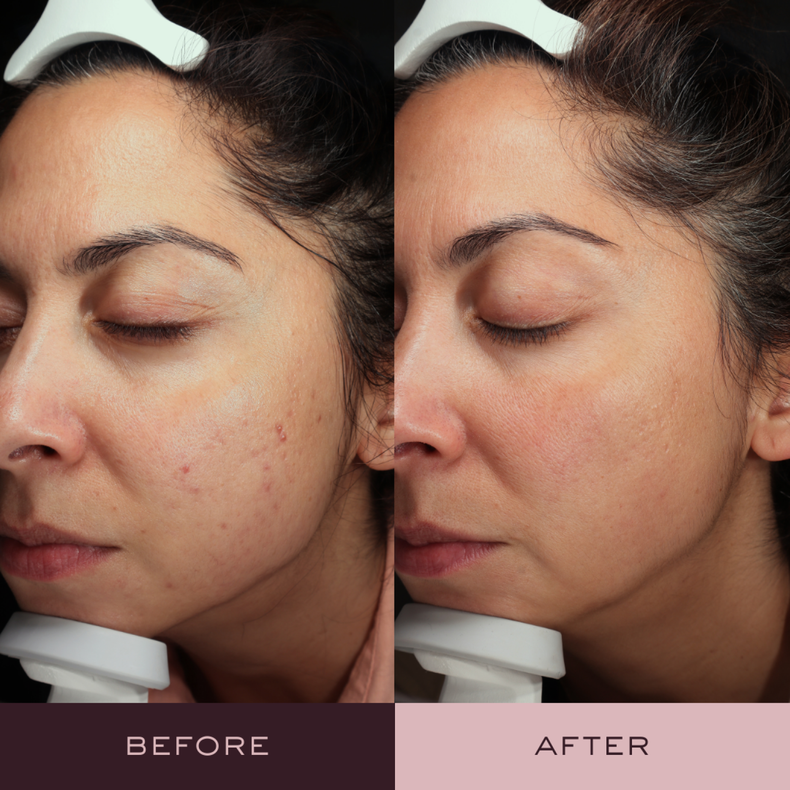 Before and after AviClear acne treatment