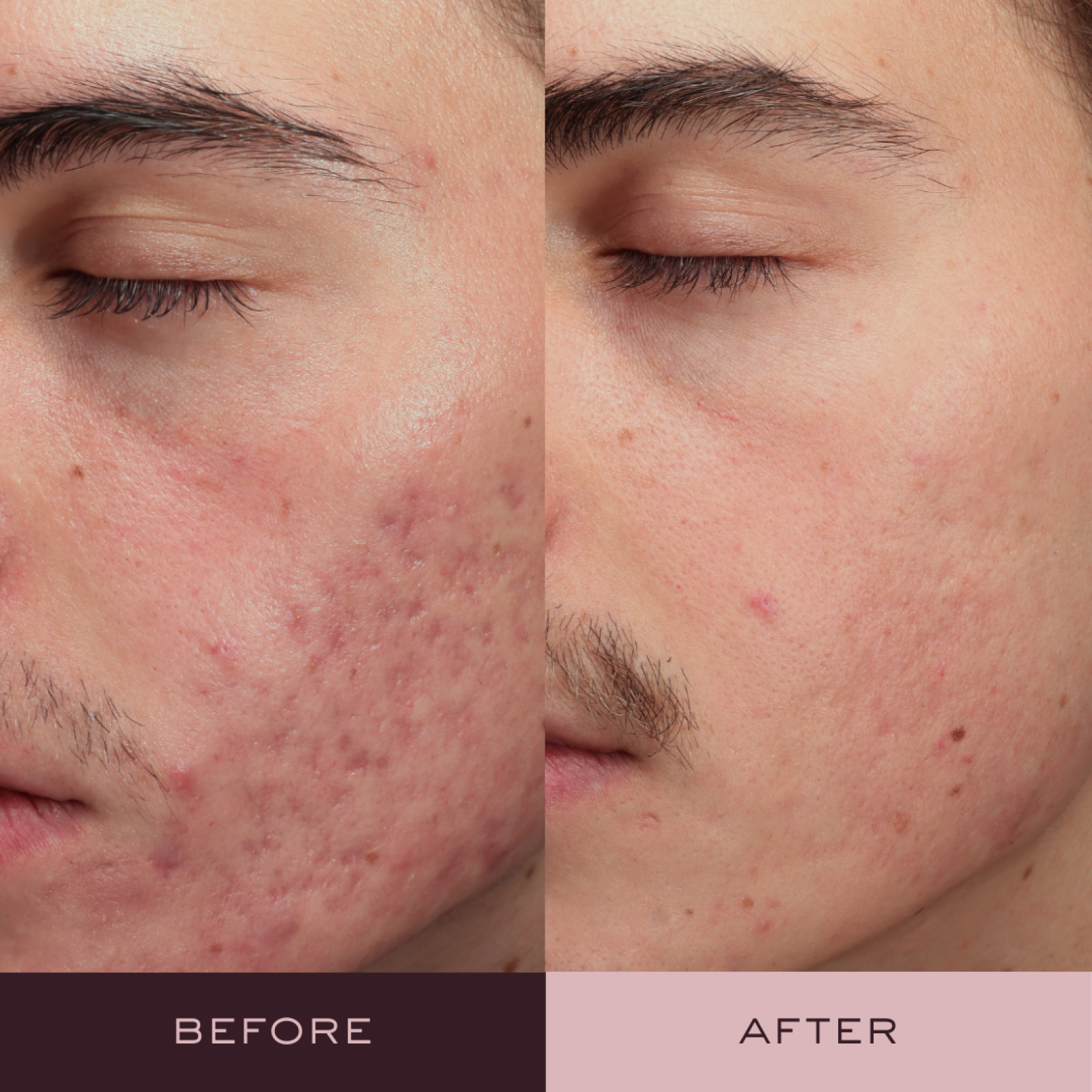Before and after AviClear acne treatment