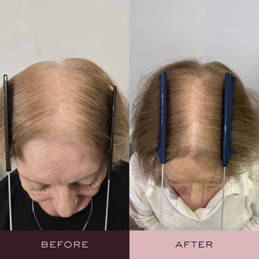 Before and after hair loss treatment