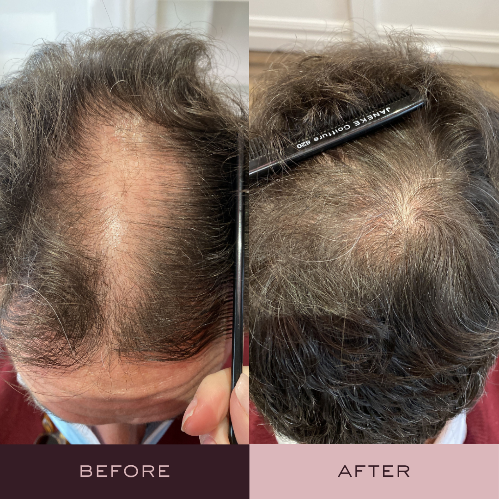 Before and after hair loss treatment