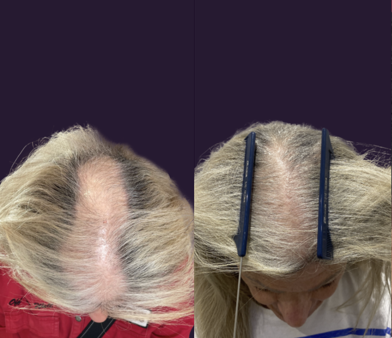Before and after hair loss treatment