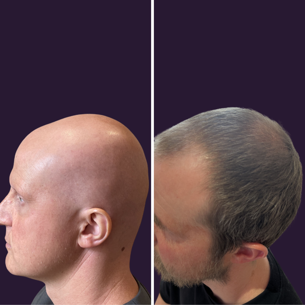 Before and after hair loss treatment