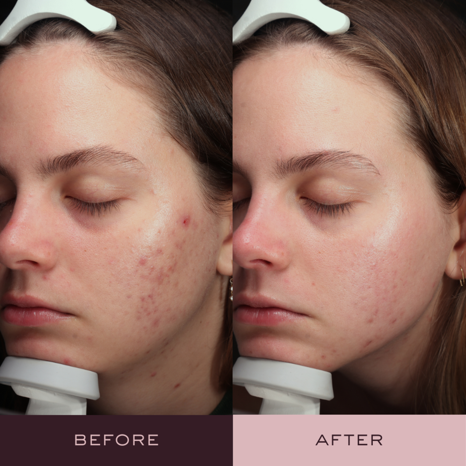 Before and after AviClear acne treatment