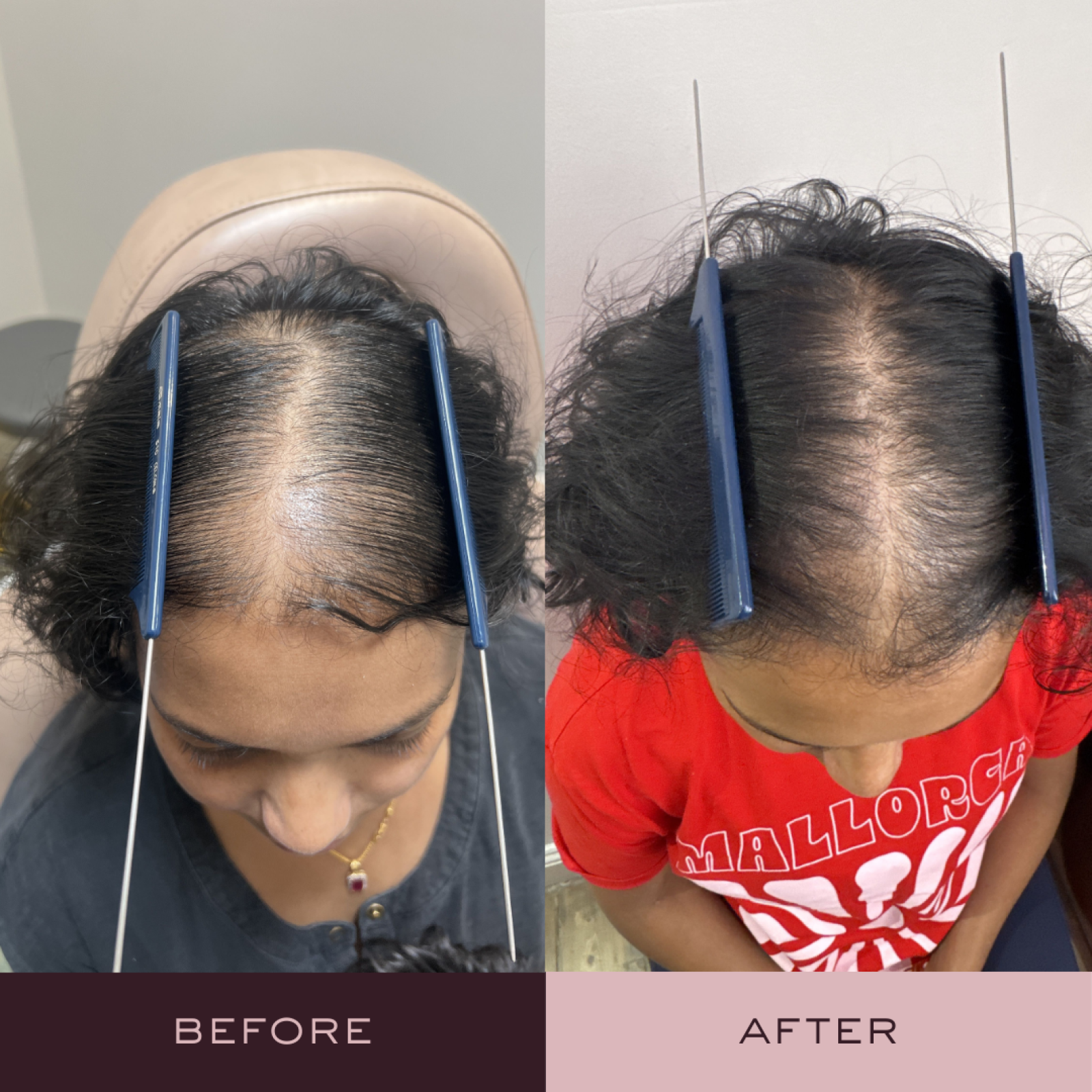 Before and after hair loss treatment