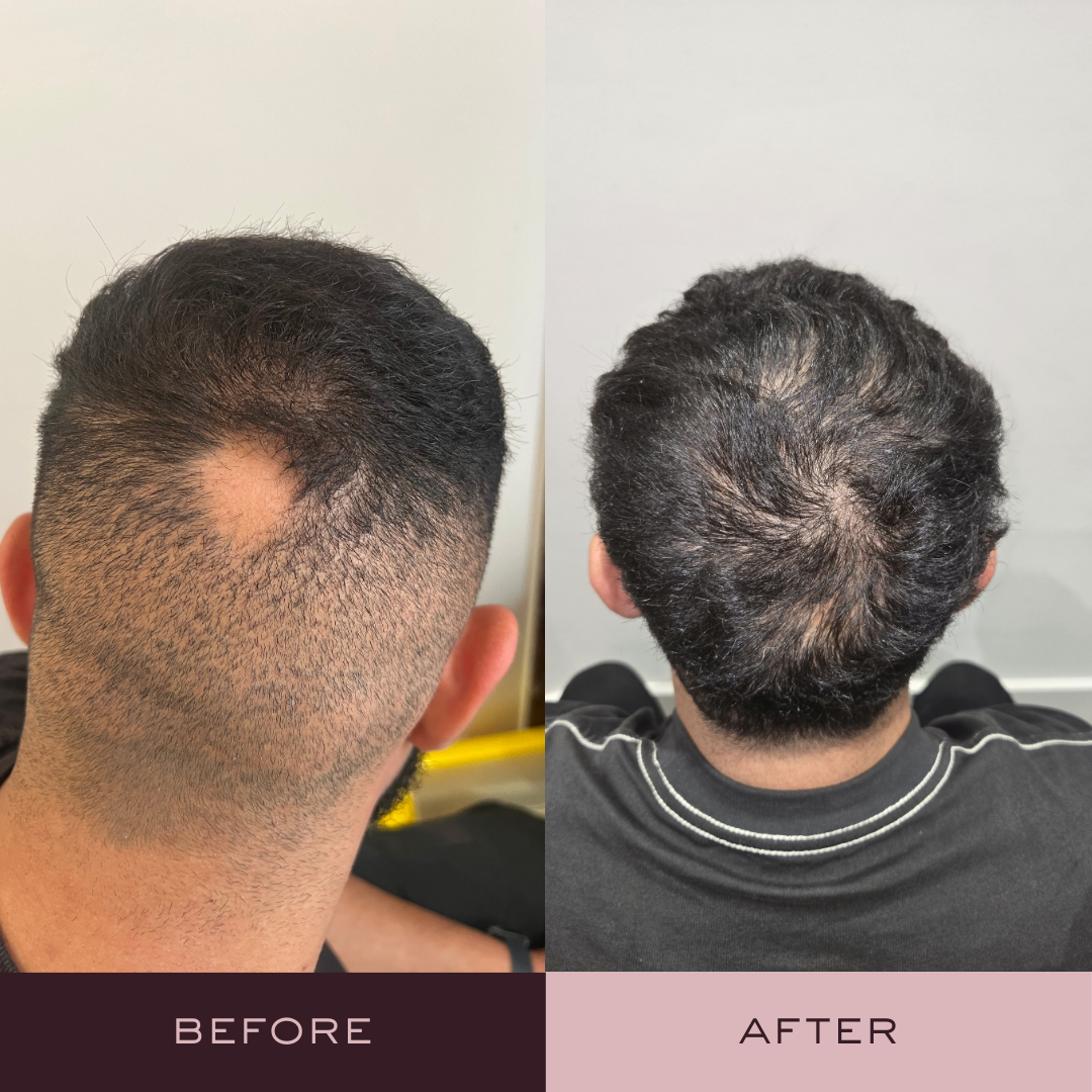 Before and after hair loss treatment