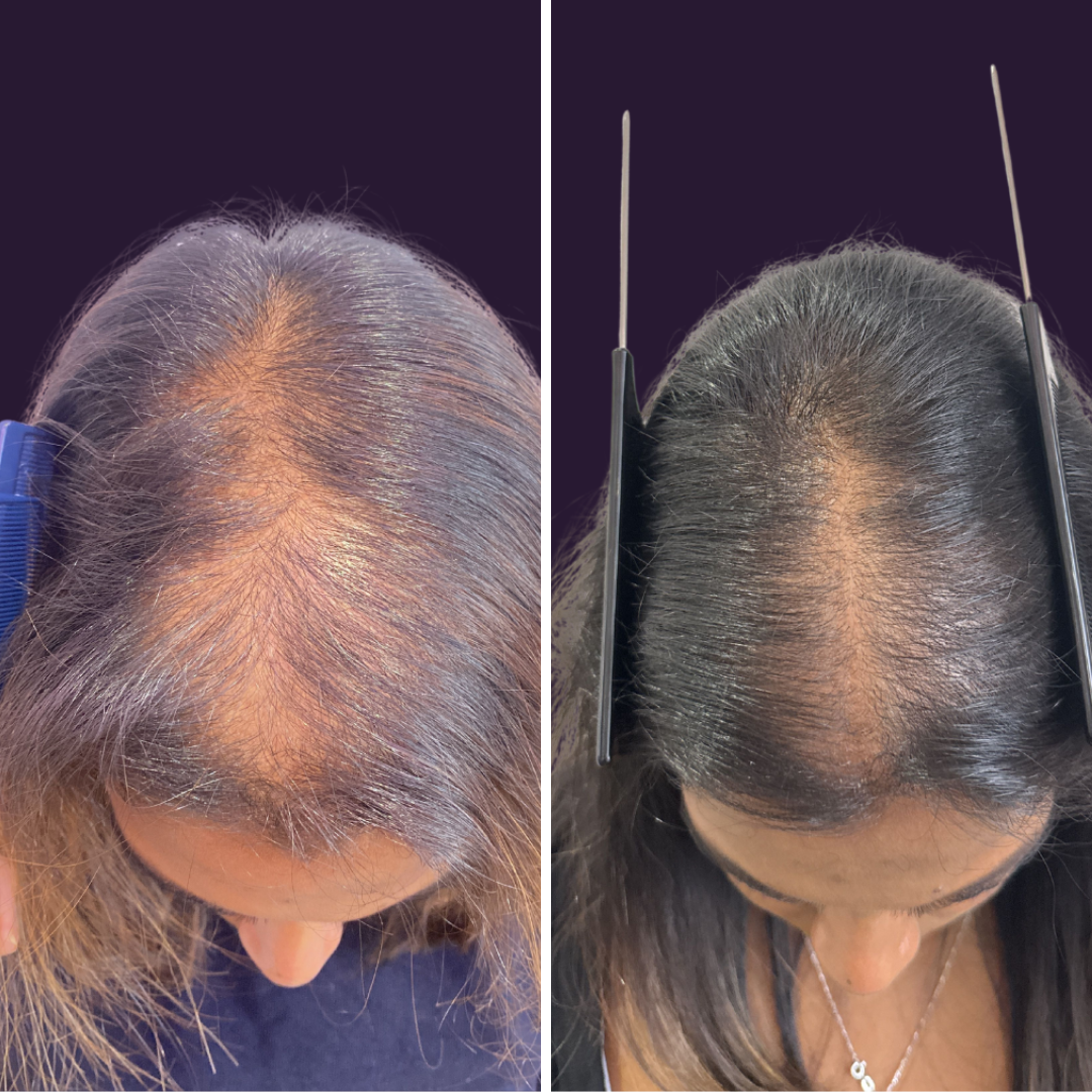 Before and after hair loss treatment